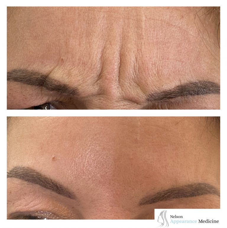 Before & After Botox® Nelson Appearance Medicine